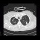 Postspecific changes in lung: CT - Computed tomography